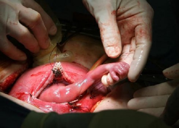 Aborto - mão