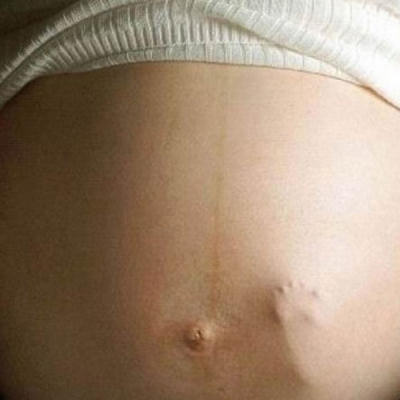 Bebê na barriga - aborto